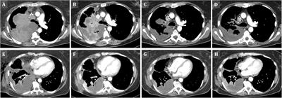 Case report: Immunovirotherapy as a novel add-on treatment in a patient with thoracic NUT carcinoma